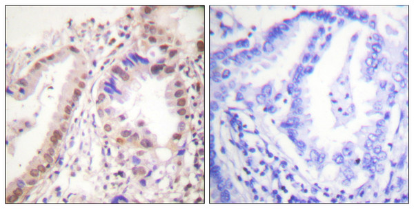 Immunohistochemistry analysis of paraffin-embedded human lung carcinoma tissue, using Estrogen Receptor-alpha Antibody. The picture on the right is blocked with the synthesized peptide.