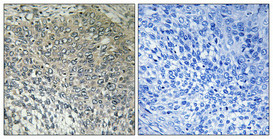 Immunohistochemical analysis of paraffin-embedded Human cervix cancer. Antibody was diluted at 1:100 (4°C overnight). High-pressure and temperature Tris-EDTA, pH8.0 was used for antigen retrieval. Negetive contrl (right) obtaned from antibody was pre-absorbed by immunogen peptide.
