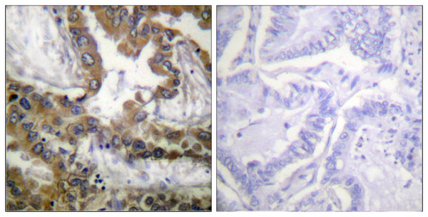 Immunohistochemistry analysis of paraffin-embedded human lung carcinoma tissue, using VEGFR2 Antibody. The picture on the right is blocked with the synthesized peptide.