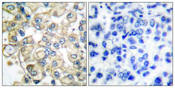 Immunohistochemistry analysis of paraffin-embedded human breast carcinoma tissue, using FGFR1 Oncogene Partner Antibody. The picture on the right is blocked with the synthesized peptide.