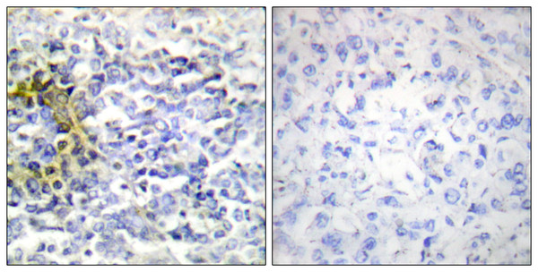 Immunohistochemistry analysis of paraffin-embedded human lung carcinoma tissue, using FXR2 Antibody. The picture on the right is blocked with the synthesized peptide.