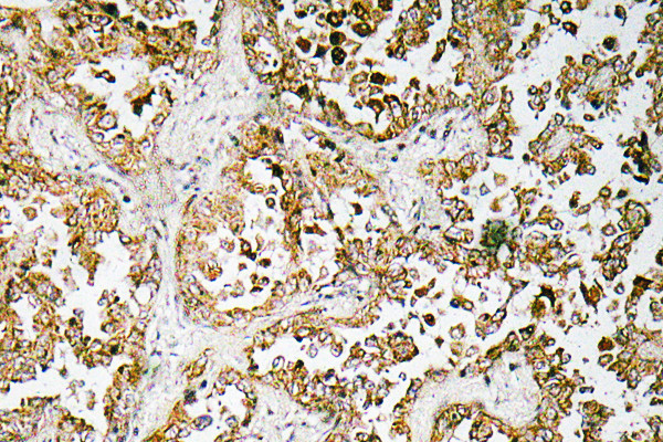 Immunohistochemistry analysis of GATA-5 antibody in paraffin-embedded human lung carcinoma tissue.