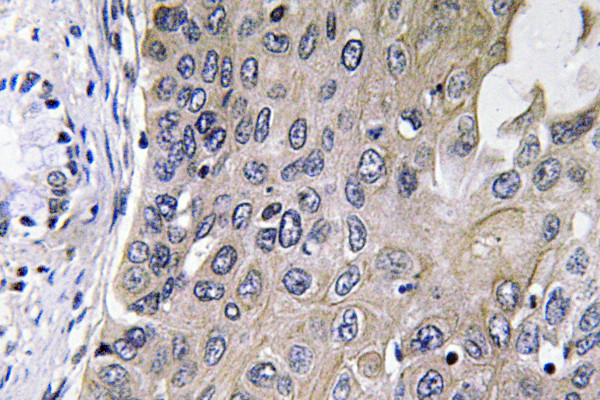 Immunohistochemistry analysis of GCS-Alpha-1 antibody in paraffin-embedded human lung carcinoma tissue. Immunohistochemistry analysis of GCS-Alpha-1 antibody in paraffin-embedded human lung carcinoma tissue.
