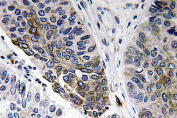 Immunohistochemistry analysis of IgA antibody in paraffin-embedded human lung carcinoma tissue. Immunohistochemistry analysis of IgA antibody in paraffin-embedded human lung carcinoma tissue.