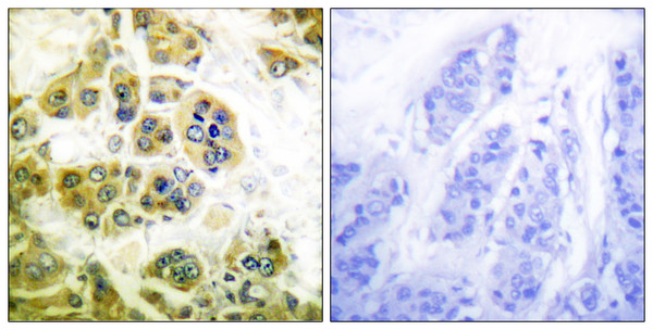 Immunohistochemistry analysis of paraffin-embedded human breast carcinoma tissue, using IKK-alpha/beta Antibody. The picture on the right is blocked with the synthesized peptide.