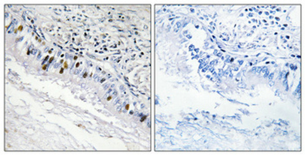 Immunohistochemical analysis of paraffin-embedded Human lung cancer. Antibody was diluted at 1:100 (4°C overnight). High-pressure and temperature Tris-EDTA, pH8.0 was used for antigen retrieval. Negetive contrl (right) obtaned from antibody was pre-absorbed by immunogen peptide. Immunohistochemical analysis of paraffin-embedded Human lung cancer. Antibody was diluted at 1:100 (4°C overnight). High-pressure and temperature Tris-EDTA, pH8.0 was used for antigen retrieval. Negetive contrl (right) obtaned from antibody was pre-absorbed by immunogen peptide.