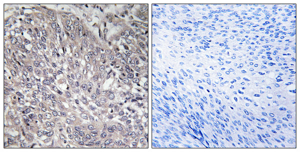 Immunohistochemistry analysis of paraffin-embedded human cervix carcinoma tissue, using InsP3R1 Antibody. The picture on the right is blocked with the synthesized peptide.