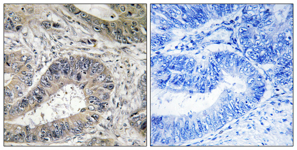 Immunohistochemistry analysis of paraffin-embedded human colon carcinoma tissue, using ERN2 Antibody. The picture on the right is blocked with the synthesized peptide.