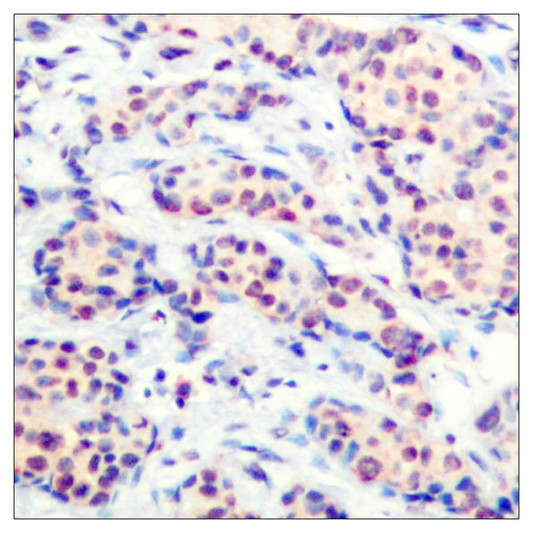 Immunohistochemistry analysis of paraffin-embedded human breast carcinoma tissue, using JunD Antibody. The picture on the right is blocked with the synthesized peptide.