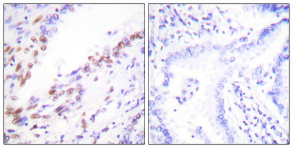Immunohistochemistry analysis of paraffin-embedded human lung carcinoma tissue, using Ki67 Antibody. The picture on the right is blocked with the synthesized peptide.