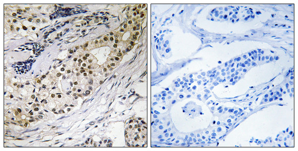 Immunohistochemistry analysis of paraffin-embedded human colon carcinoma tissue, using LAMA3 Antibody. The picture on the right is blocked with the synthesized peptide. Immunohistochemistry analysis of paraffin-embedded human colon carcinoma tissue, using LAMA3 Antibody. The picture on the right is blocked with the synthesized peptide.