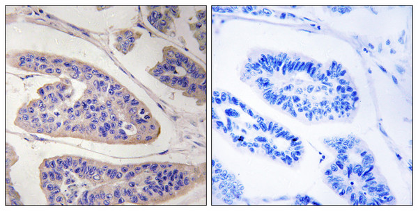 Immunohistochemistry analysis of paraffin-embedded human breast carcinoma tissue, using ENAH Antibody. The picture on the right is blocked with the synthesized peptide.