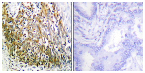 Immunohistochemistry analysis of paraffin-embedded human lung carcinoma tissue, using MMP-10 Antibody. The picture on the right is blocked with the synthesized peptide.