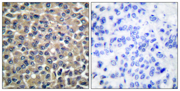 Immunohistochemistry analysis of paraffin-embedded human breast carcinoma tissue, using MMP-19 Antibody. The picture on the right is blocked with the synthesized peptide.