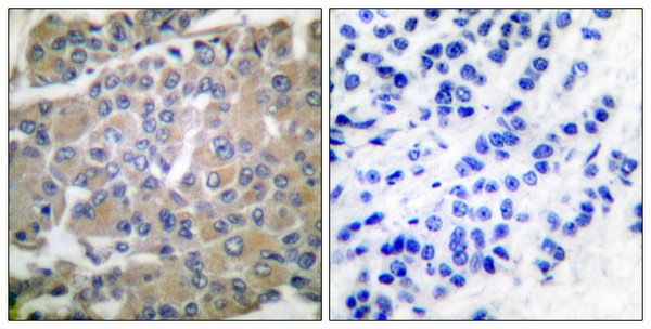 Immunohistochemistry analysis of paraffin-embedded human breast carcinoma tissue, using MMP-8 Antibody. The picture on the right is blocked with the synthesized peptide. Immunohistochemistry analysis of paraffin-embedded human breast carcinoma tissue, using MMP-8 Antibody. The picture on the right is blocked with the synthesized peptide.