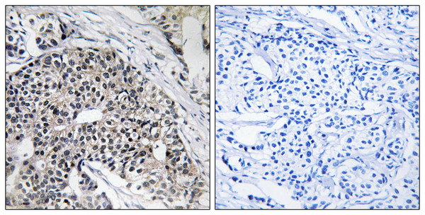 Immunohistochemistry analysis of paraffin-embedded human breast carcinoma tissue, using MRPL24 Antibody. The picture on the right is blocked with the synthesized peptide. Immunohistochemistry analysis of paraffin-embedded human breast carcinoma tissue, using MRPL24 Antibody. The picture on the right is blocked with the synthesized peptide.