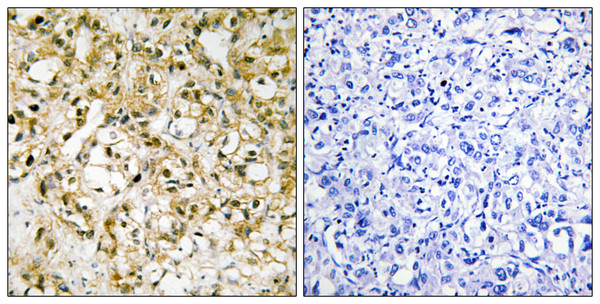 Immunohistochemistry analysis of paraffin-embedded human liver carcinoma tissue, using TFAM Antibody. The picture on the right is blocked with the synthesized peptide.