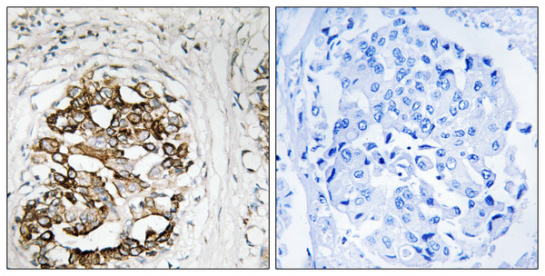 Immunohistochemistry analysis of paraffin-embedded human breast carcinoma, using MYT1 Antibody. The picture on the right is blocked with the synthesized peptide. Immunohistochemistry analysis of paraffin-embedded human breast carcinoma, using MYT1 Antibody. The picture on the right is blocked with the synthesized peptide.