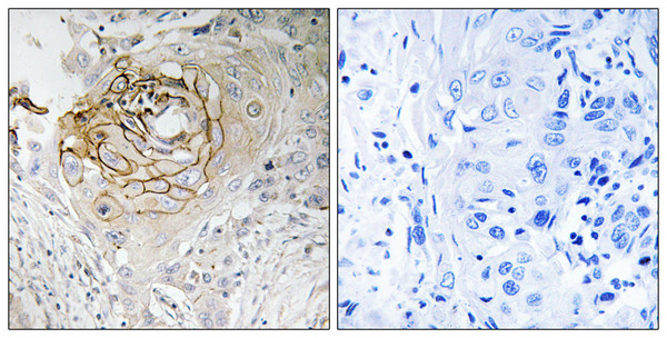 Immunohistochemistry analysis of paraffin-embedded human lung carcinoma tissue, using SCN9A Antibody. The picture on the right is blocked with the synthesized peptide.