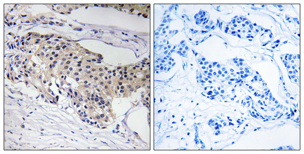 Immunohistochemistry analysis of paraffin-embedded human breast carcinoma tissue, using NDUFA3 Antibody. The picture on the right is blocked with the synthesized peptide.