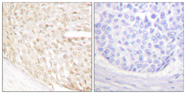 Immunohistochemistry analysis of paraffin-embedded human breast carcinoma tissue, using p18 INK Antibody. The picture on the right is blocked with the synthesized peptide.