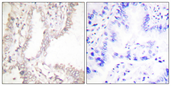 Immunohistochemistry analysis of paraffin-embedded human lung carcinoma tissue, using Prostate Apoptosis Response protein-4 Antibody. The picture on the right is blocked with the synthesized peptide.