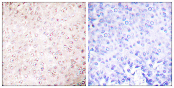 Immunohistochemistry analysis of paraffin-embedded human breast carcinoma tissue, using p300/CBP Antibody. The picture on the right is blocked with the synthesized peptide.
