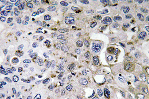 Immunohistochemistry analysis of PDGF-A antibody in paraffin-embedded human lung carcinoma tissue.