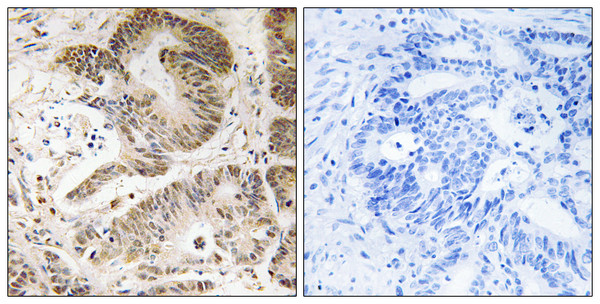 Immunohistochemistry analysis of paraffin-embedded human colon carcinoma tissue, using PIK3R5 Antibody. The picture on the right is blocked with the synthesized peptide.