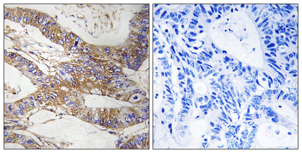 Immunohistochemistry analysis of paraffin-embedded human colon carcinoma tissue, using SERPINB9 Antibody. The picture on the right is blocked with the synthesized peptide.
