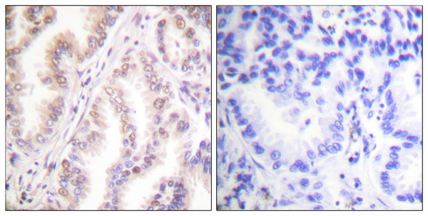 Immunohistochemistry analysis of paraffin-embedded human lung carcinoma tissue, using PIAS1 Antibody. The picture on the right is blocked with the synthesized peptide.