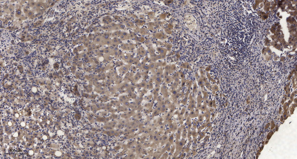 Immunohistochemical analysis of paraffin-embedded human liver cancer. 1, Antibody was diluted at 1:200 (4°C overnight). 2, Tris-EDTA, pH9.0 was used for antigen retrieval. 3, Secondary antibody was diluted at 1:200 (room temperature, 45min).