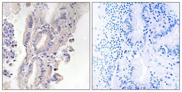 Immunohistochemistry analysis of paraffin-embedded human lung carcinoma, using PLCXD1 Antibody. The picture on the right is blocked with the synthesized peptide.