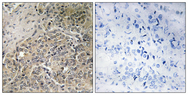 Immunohistochemistry analysis of paraffin-embedded human prostate carcinoma, using A26C2/3 Antibody. The picture on the right is blocked with the synthesized peptide.