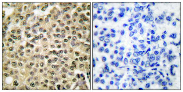 Immunohistochemistry analysis of paraffin-embedded human breast carcinoma tissue, using RAN Antibody. The picture on the right is blocked with the synthesized peptide.