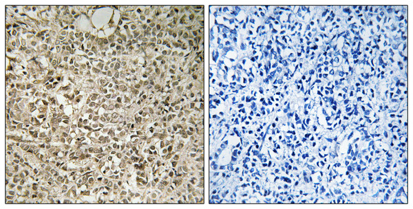 Immunohistochemistry analysis of paraffin-embedded human breast carcinoma tissue, using RPL40 Antibody. The picture on the right is blocked with the synthesized peptide.