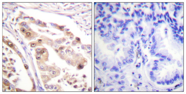 Immunohistochemistry analysis of paraffin-embedded human lung carcinoma tissue, using RFA2 Antibody. The picture on the right is blocked with the synthesized peptide.