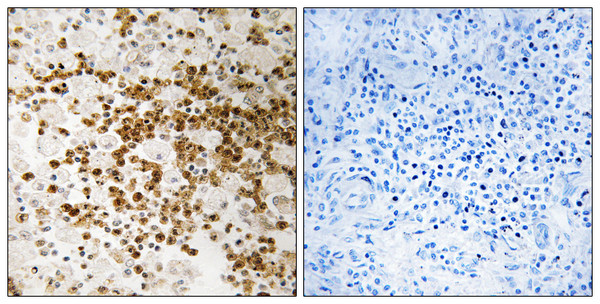Immunohistochemistryt analysis of paraffin-embedded human lung carcinoma, using S100P Antibody. The lane on the right is blocked with the S100P peptide.