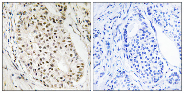Immunohistochemistry analysis of paraffin-embedded human breast carcinoma tissue, using HNRNPUL2 Antibody. The picture on the right is blocked with the synthesized peptide.