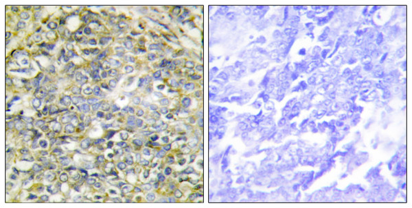 Immunohistochemistry analysis of paraffin-embedded human lung carcinoma tissue, using UBXD5 Antibody. The picture on the right is blocked with the synthesized peptide.