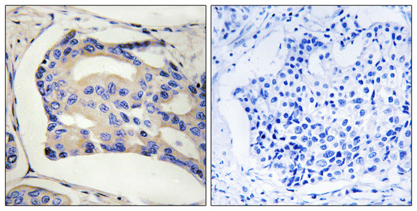 Immunohistochemistry analysis of paraffin-embedded human breast cancer, using STK32C Antibody. The picture on the right is blocked with the STK32C peptide.