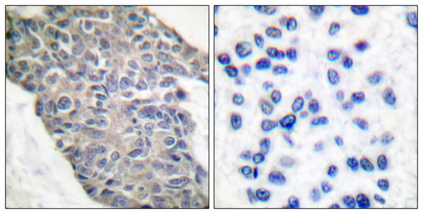 Immunohistochemistry analysis of paraffin-embedded human breast carcinoma tissue, using Synaptotagmin Antibody. The picture on the right is blocked with the synthesized peptide.