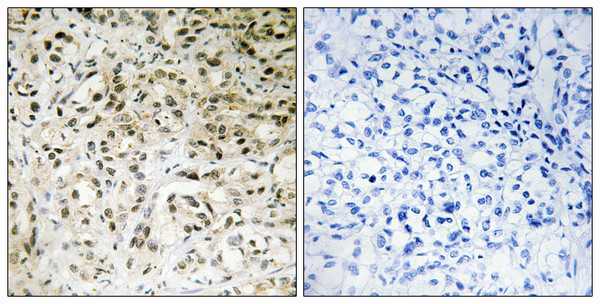 Immunohistochemistry analysis of paraffin-embedded human liver carcinoma tissue, using TAF5 Antibody. The picture on the right is blocked with the synthesized peptide.