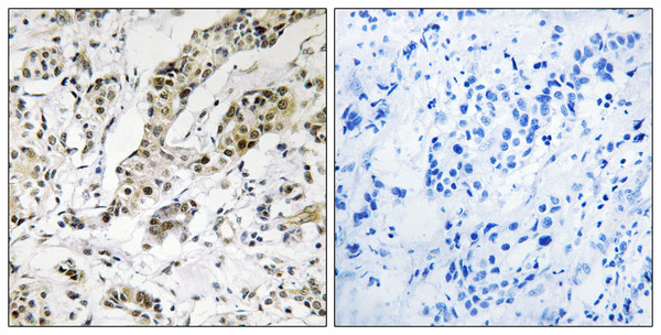 Immunohistochemistry analysis of paraffin-embedded human breast carcinoma, using TCEAL3/5/6 Antibody. The picture on the right is blocked with the synthesized peptide.