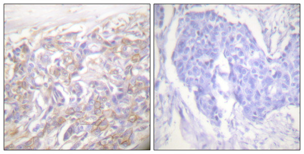 Immunohistochemistry analysis of paraffin-embedded human breast carcinoma tissue, using TNF Receptor I Antibody. The picture on the right is blocked with the synthesized peptide.