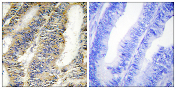 Immunohistochemistry analysis of paraffin-embedded human colon carcinoma tissue, using TNFA Antibody. The picture on the right is blocked with the synthesized peptide.