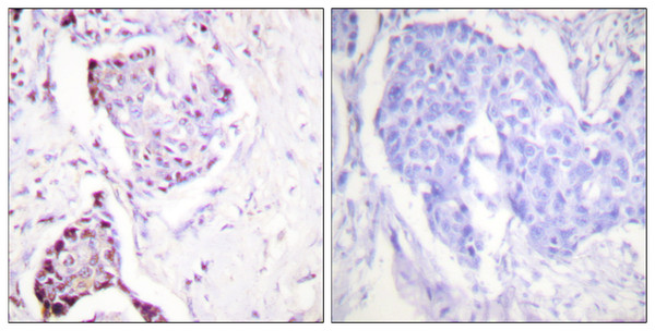 Immunohistochemistry analysis of paraffin-embedded human breast carcinoma tissue, using Ubiquitin Antibody. The picture on the right is blocked with the synthesized peptide.