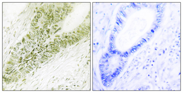 Immunohistochemistry analysis of paraffin-embedded human colon carcinoma tissue, using Ubinuclein Antibody. The picture on the right is blocked with the synthesized peptide.