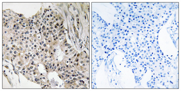 Immunohistochemistry analysis of paraffin-embedded human breast carcinoma tissue, using UEVLD Antibody. The picture on the right is blocked with the synthesized peptide.