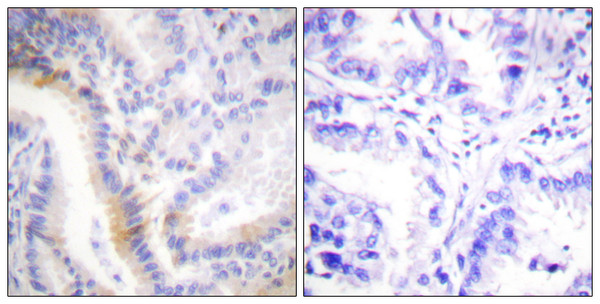 Immunohistochemistry analysis of paraffin-embedded human lung carcinoma tissue, using Urocortin Antibody. The picture on the right is blocked with the synthesized peptide.
